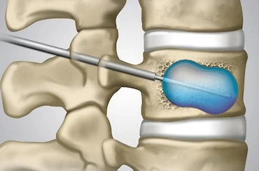KYPHOPLASTY 1